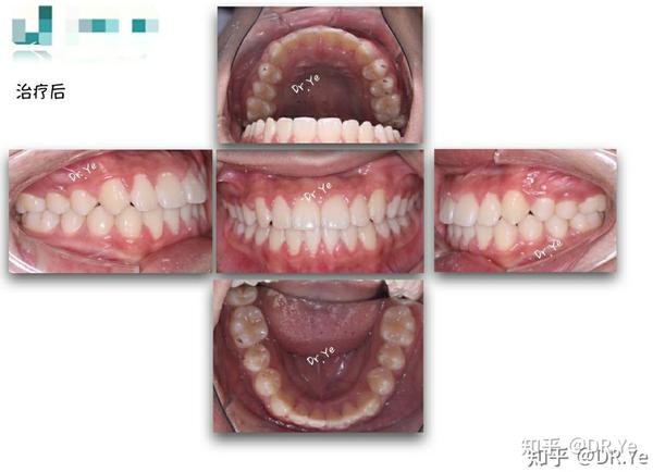 地包天分为 1牙性 2功能性 3骨性.