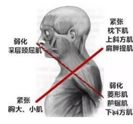 圆肩驼背头前引的肌动学分析