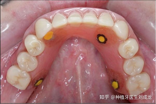 郑州瑞士iti种植牙:种植导板下无牙颌种植修复,恢复全