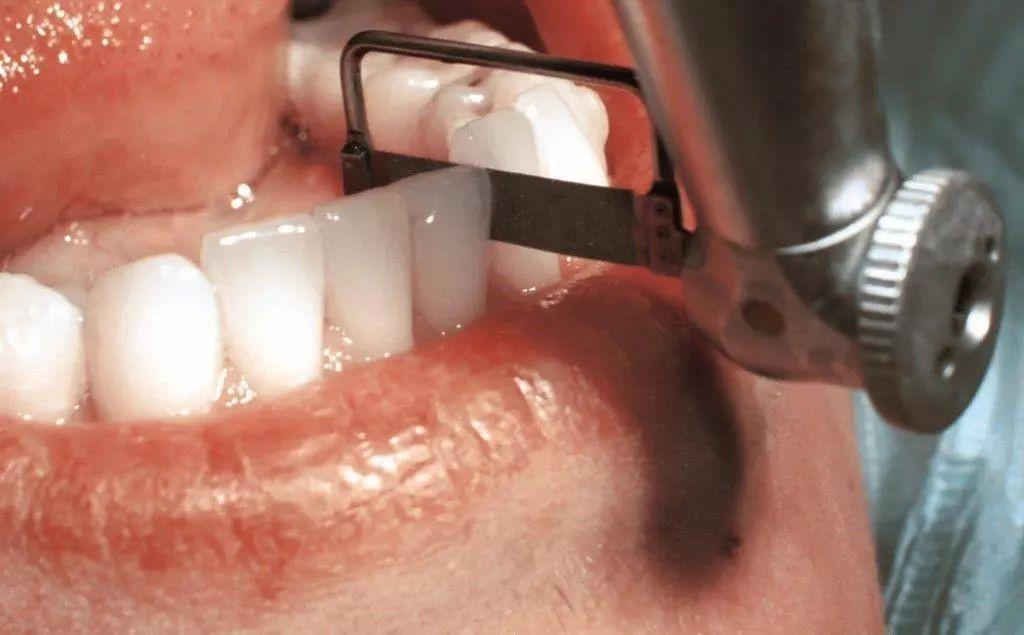 牙齿矫正为什么要片切是切哪疼吗