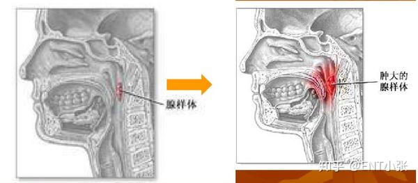 科普|小朋友鼻炎打呼,可能是因为这个——一文带你了解腺样体肥大