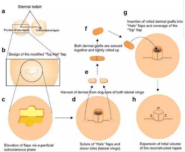 乳头乳晕再造术的研究进展