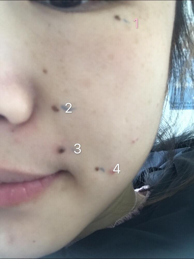 激药水痣和光点表情包动态放狗点痣那个比较1a药水?图片
