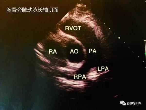 逆时针旋转10°~20°是右室流出道切面(如下图).