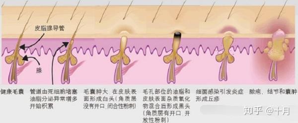 痘痘痘坑痘印的形成原因和治疗方法整理