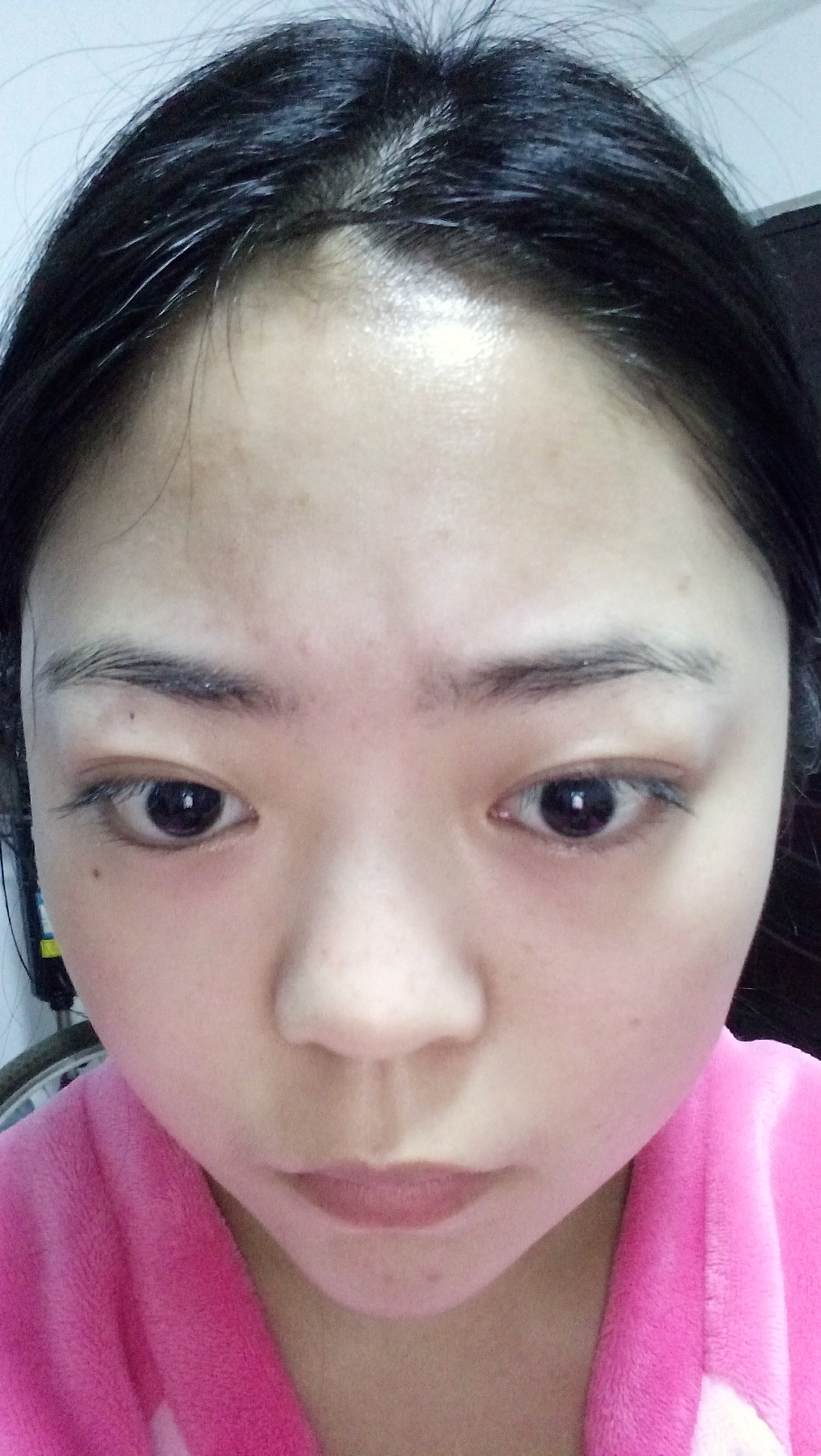 20岁女生右边脸上有色素鼻头有红痘 额头有痘