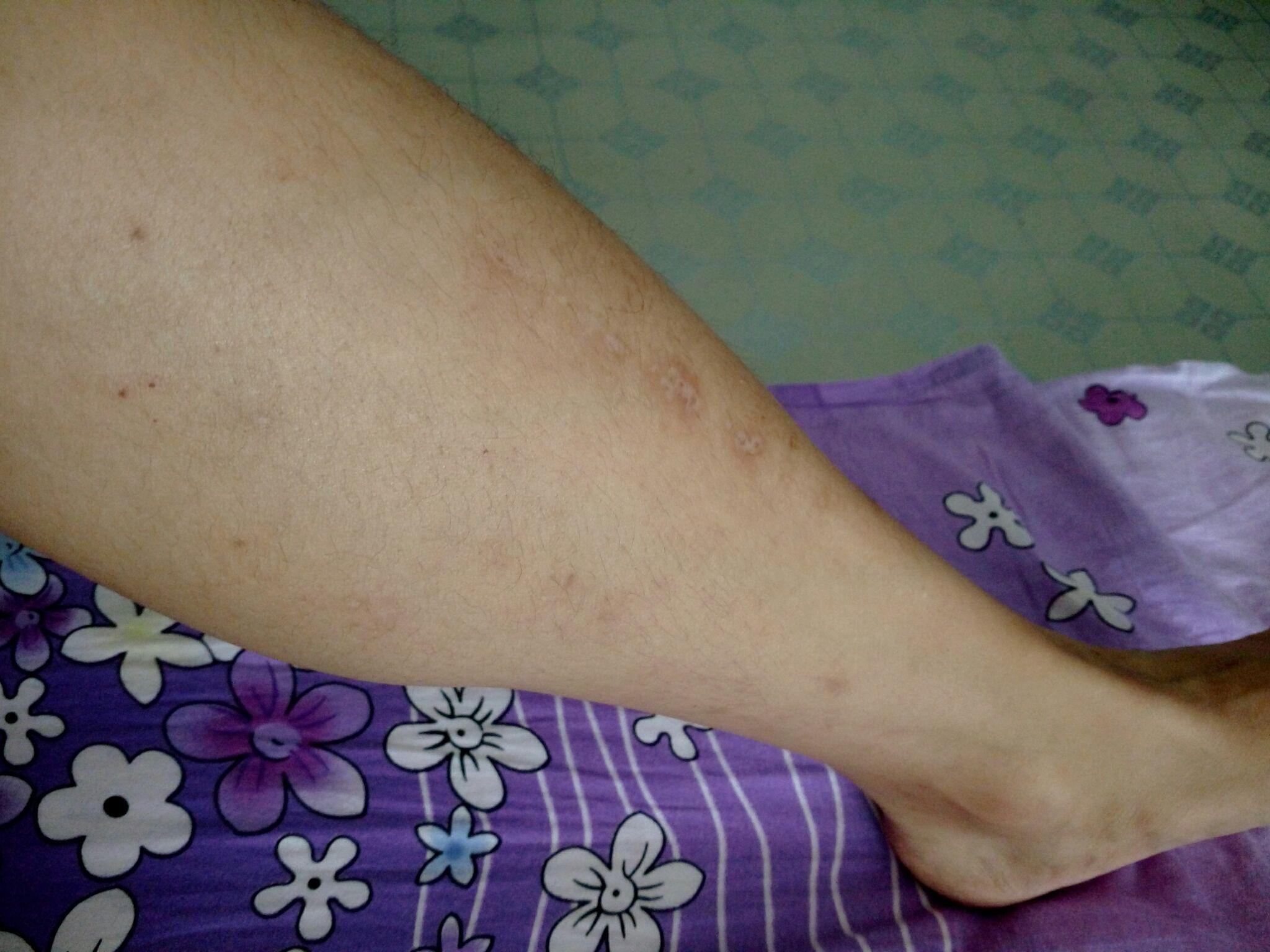 平常特别容易过敏…医生说是荨麻疹…腿上也因