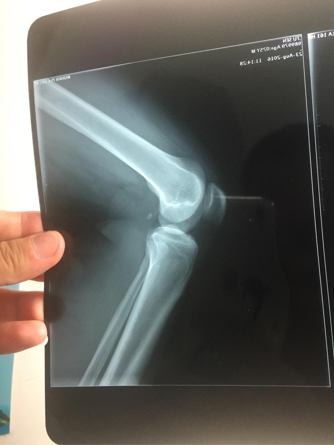 膝盖劳损如何康复? - 医学 - 知乎