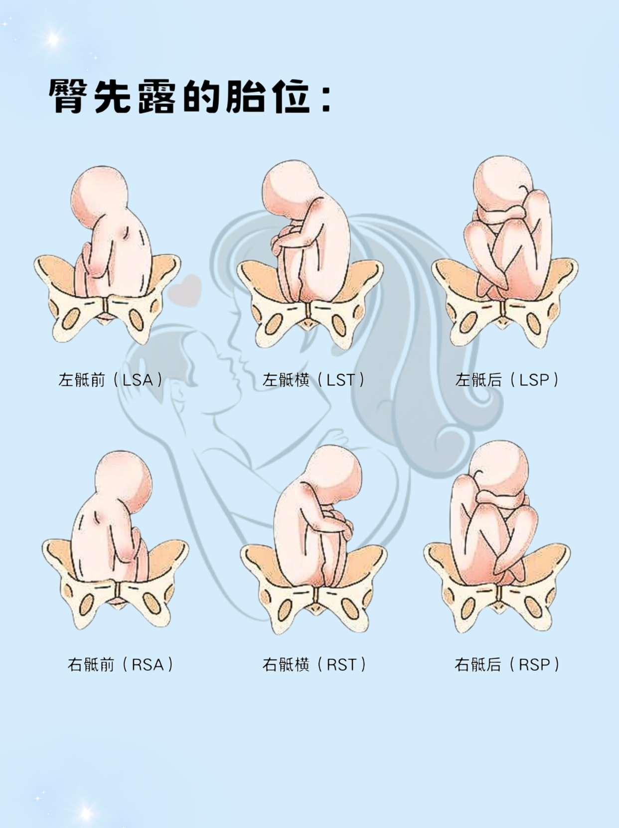 胎位图rot图片