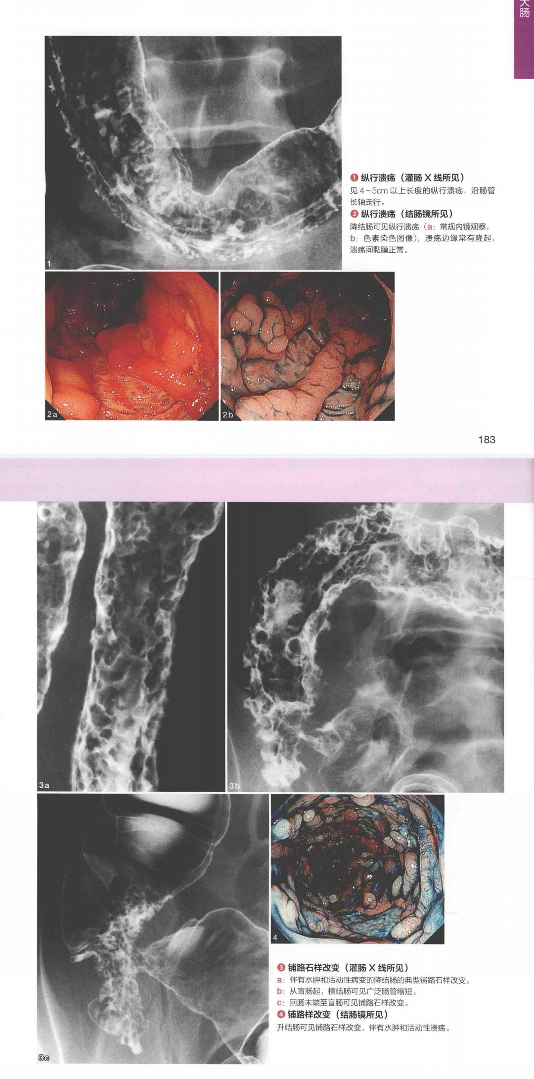医万个为什么 的想法: 克罗恩病的鉴别诊断之肠结核 | 克罗恩病的诊断