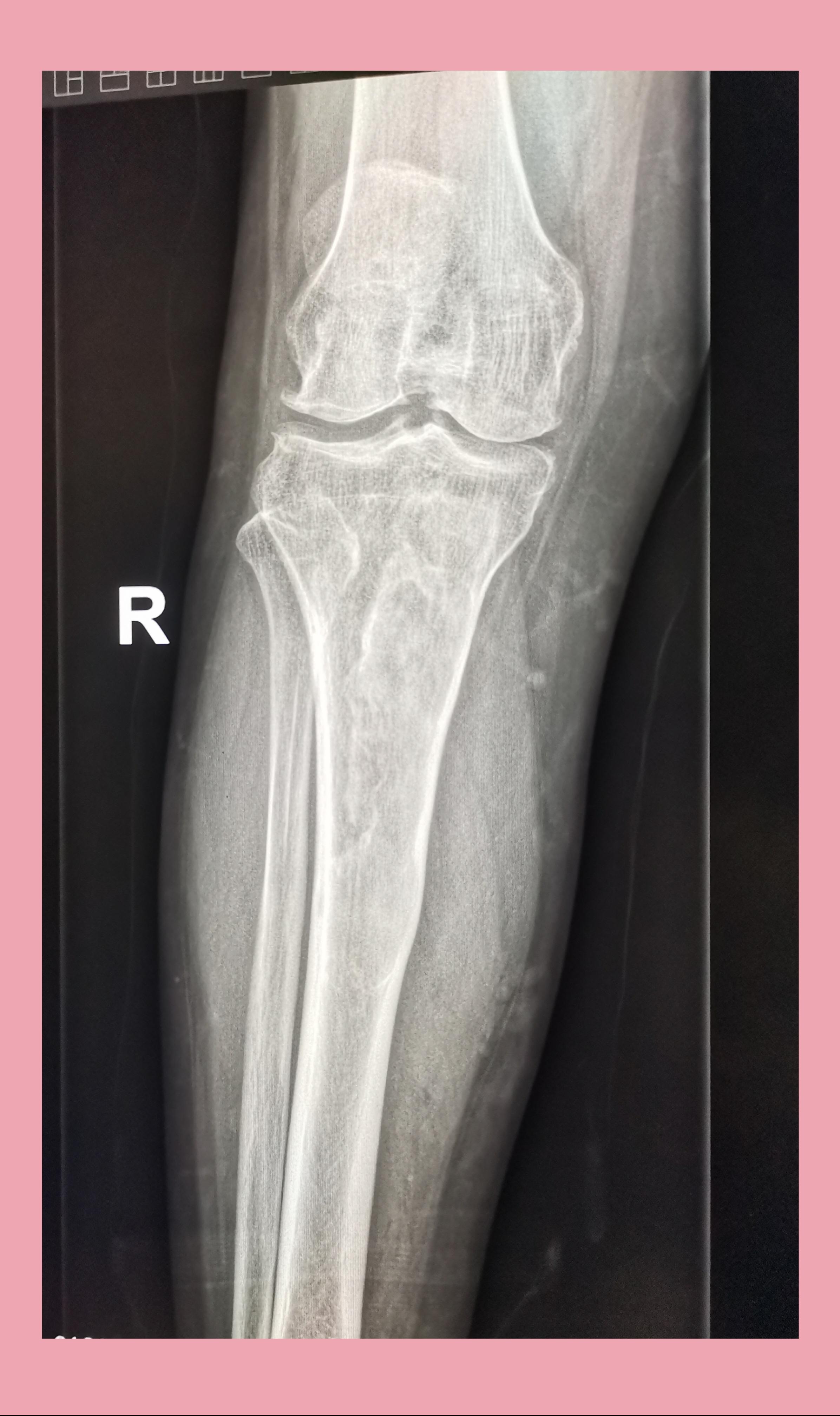 影像知识 的想法: 膝关节正侧位
