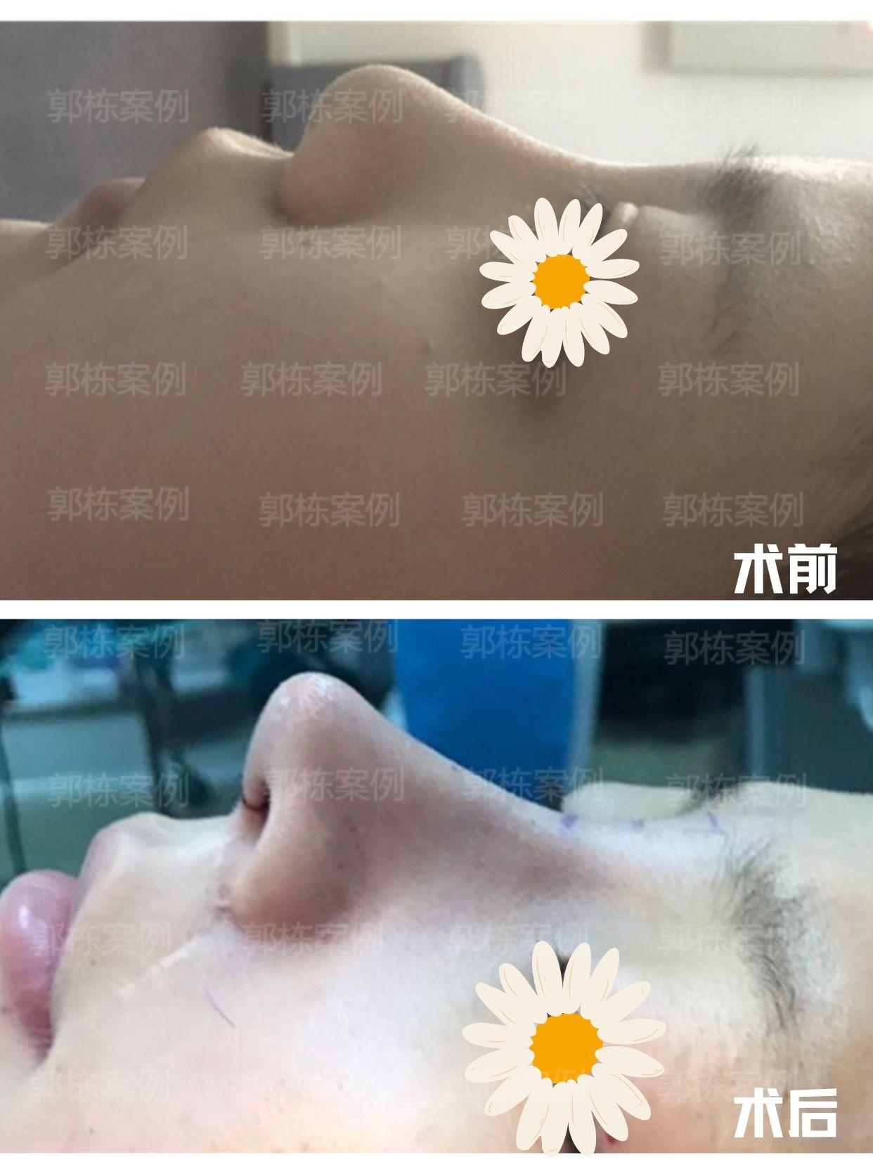 肋软骨隆鼻做完会吸收变形吗肋骨是一种致密的结缔组织器官其细胞间质