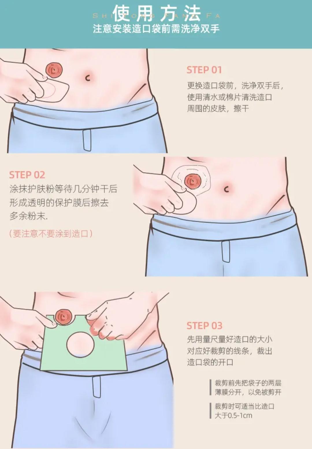 关爱造口 的想法: 造口护理的操作步骤
