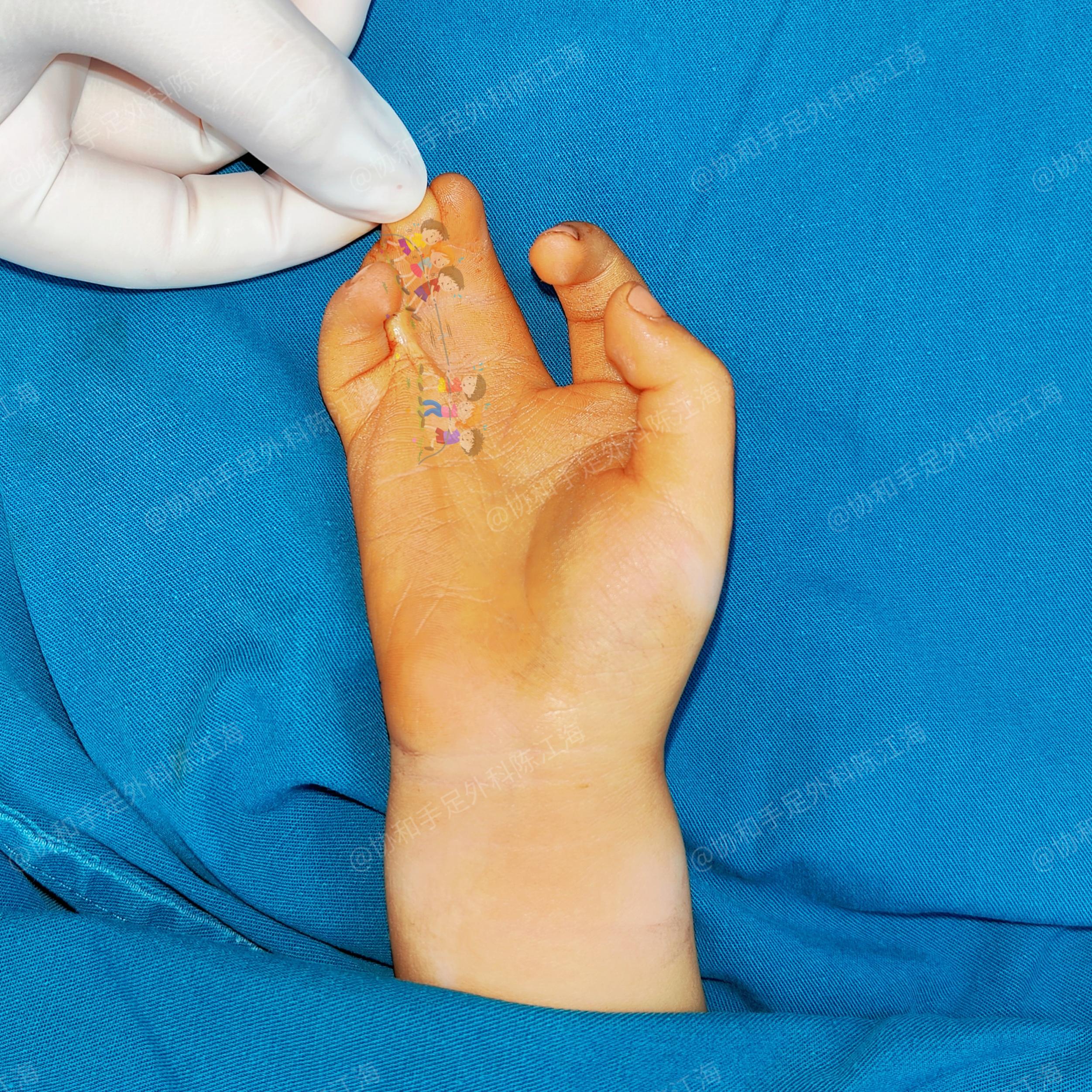 他是老二他哥哥出生的时候是并指两根手指发育没有任何问题就只是并在