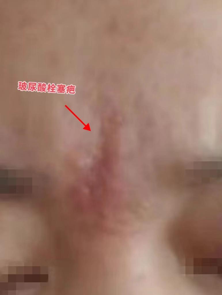 川字纹不是不可以填玻尿酸,只是有栓塞风险,严重的栓塞会堵塞血管