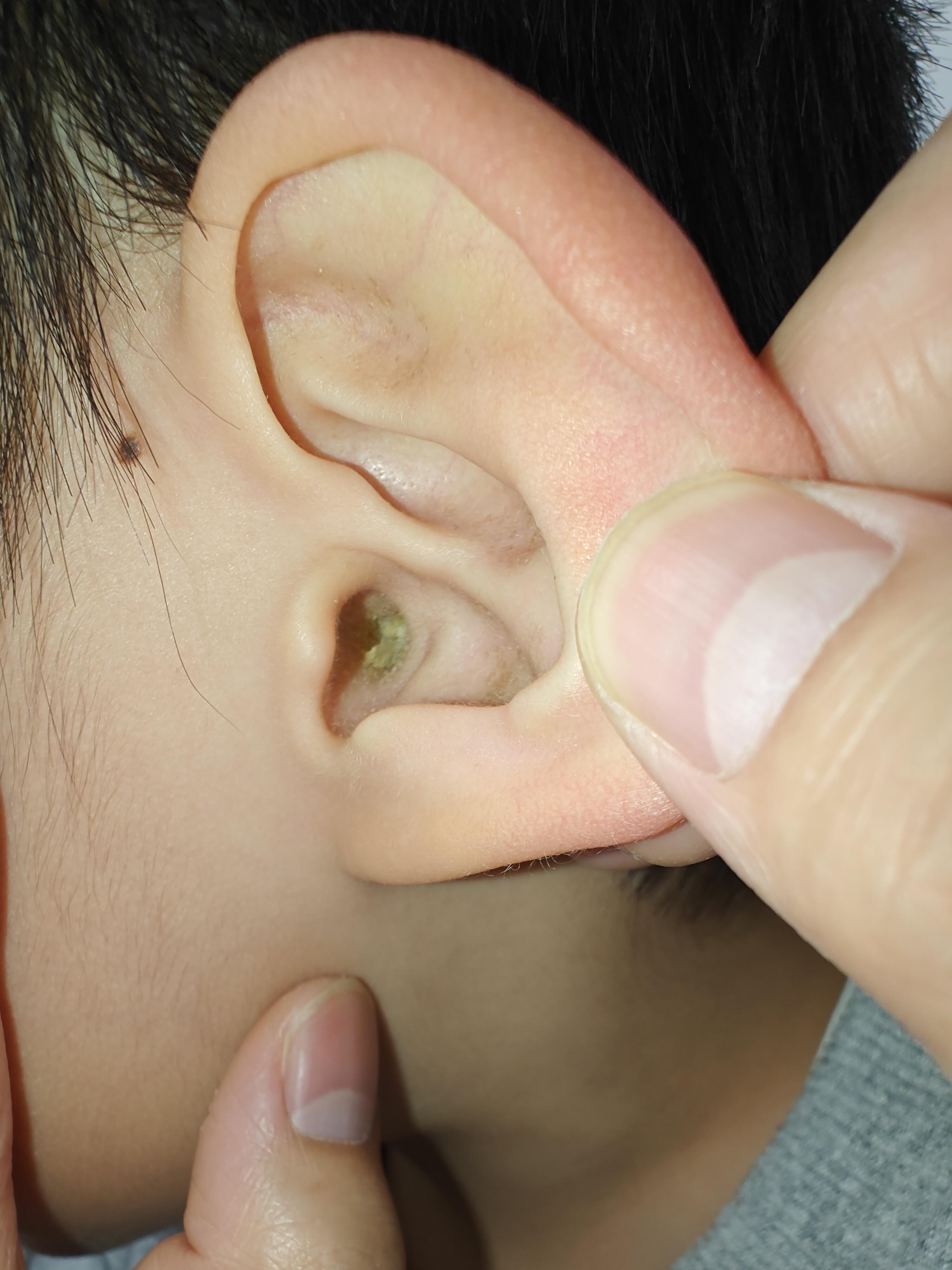 回家看到小外甥的耳朵里面有很多耳屎,听我姐说,医生建议慢慢长