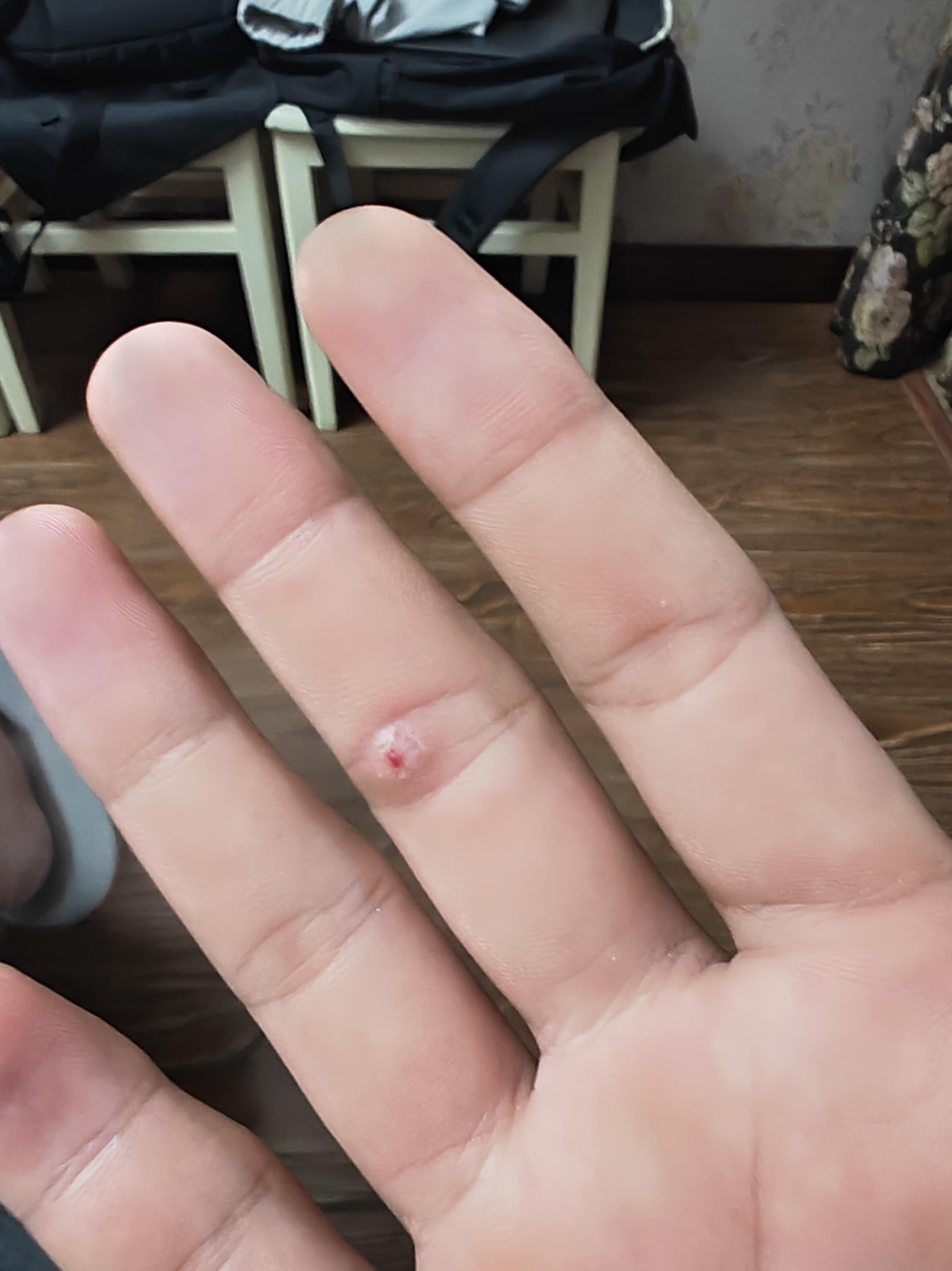 天空暂时蓝 的想法: 手上这是长了个啥啊,上次杀鱼不小心被刺了一下长