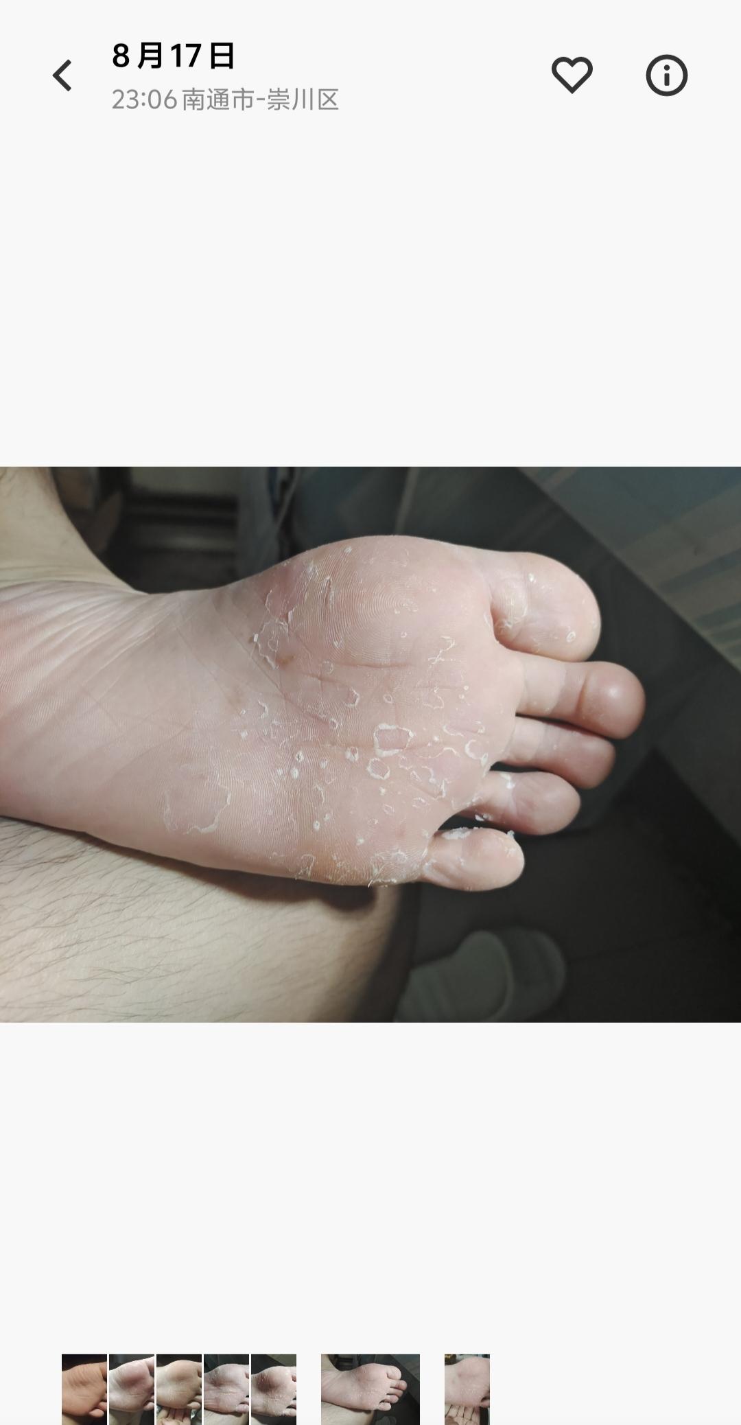 josephliao 的想法: 脚底脱皮的治疗过程