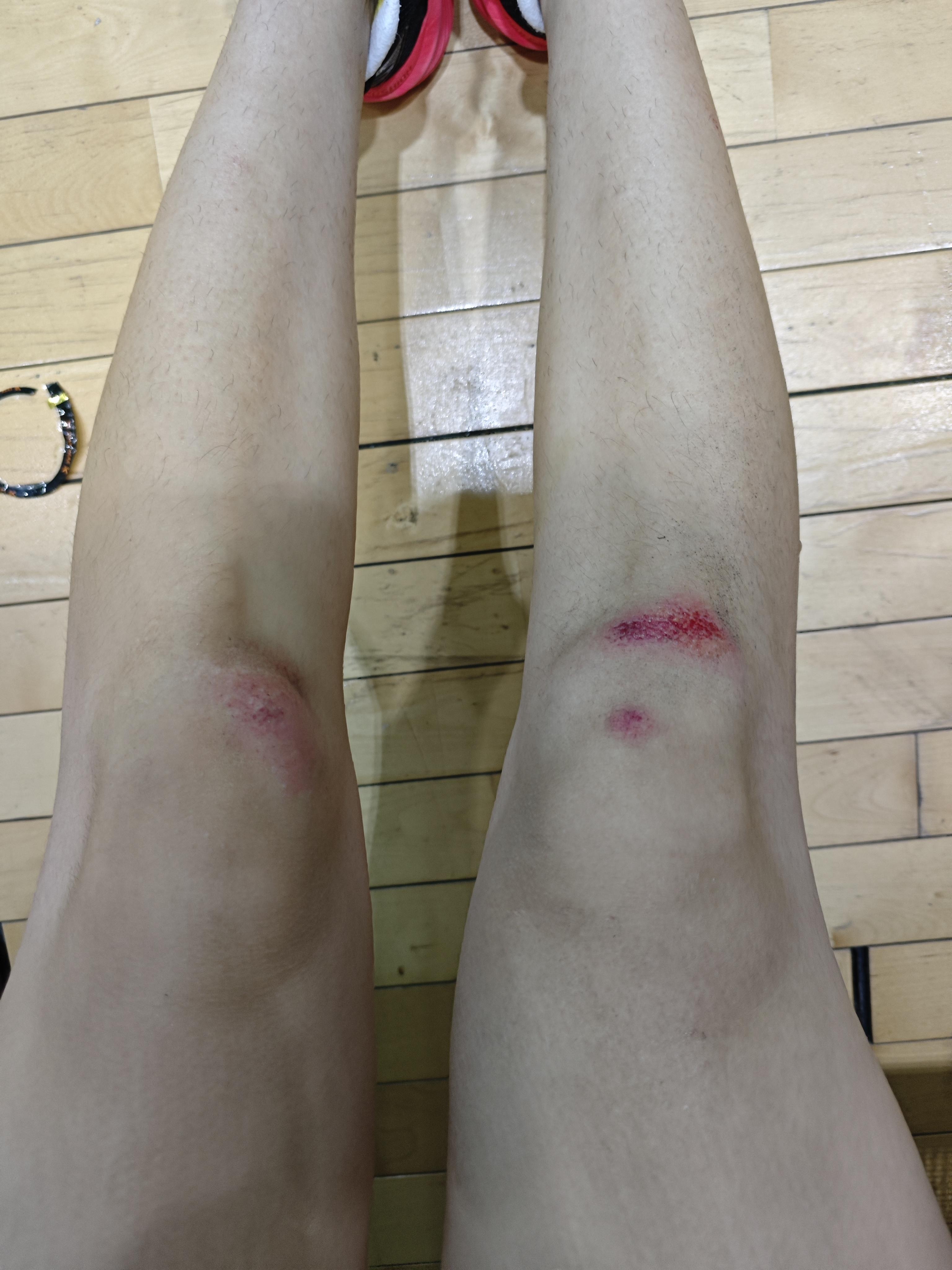 我是一只小企鹅 的想法: 打球第一次膝盖受皮外伤.挺疼的,下去买点药