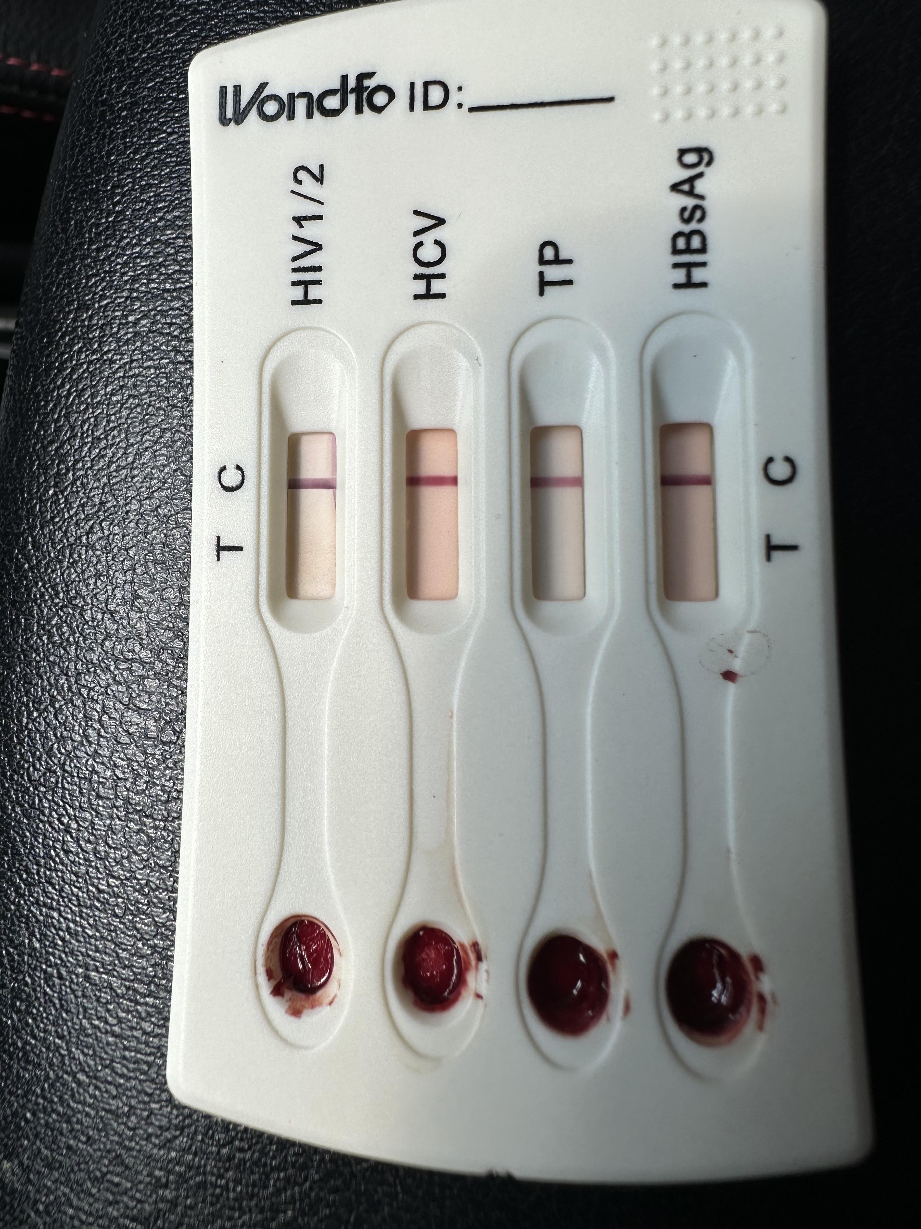 百忧解 的想法: 帮忙看看,hiv是包埋线还是中招了,15