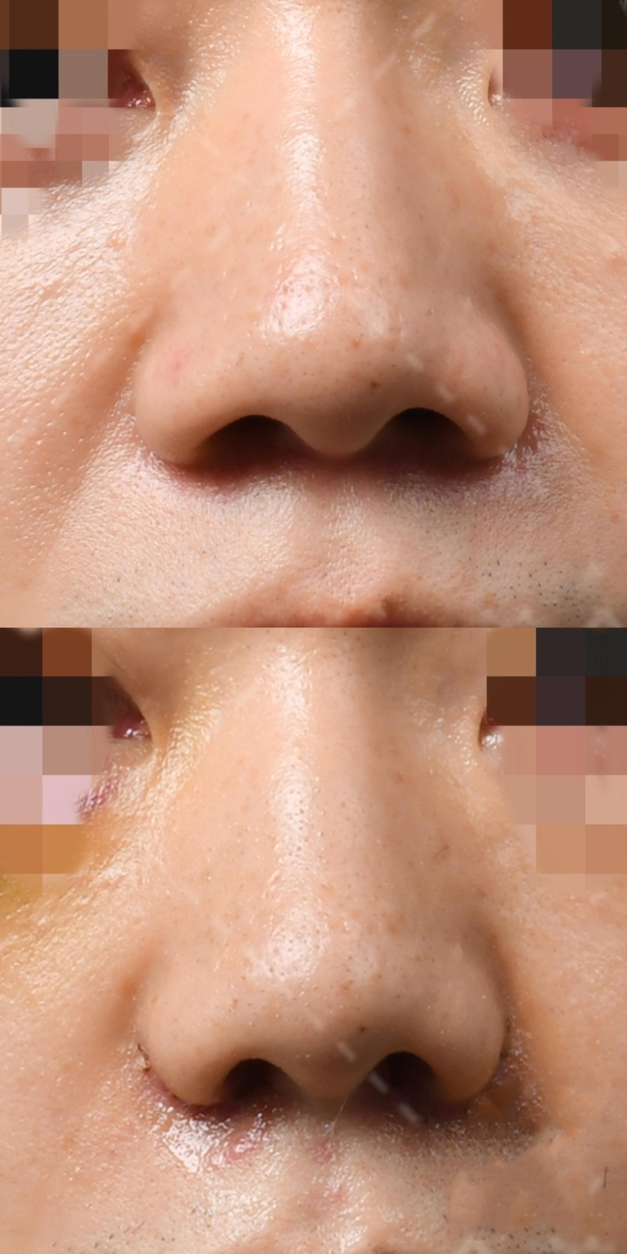 鼻大叔杜亚旭医生 的想法: 鼻翼缩小:内切和外切的区别