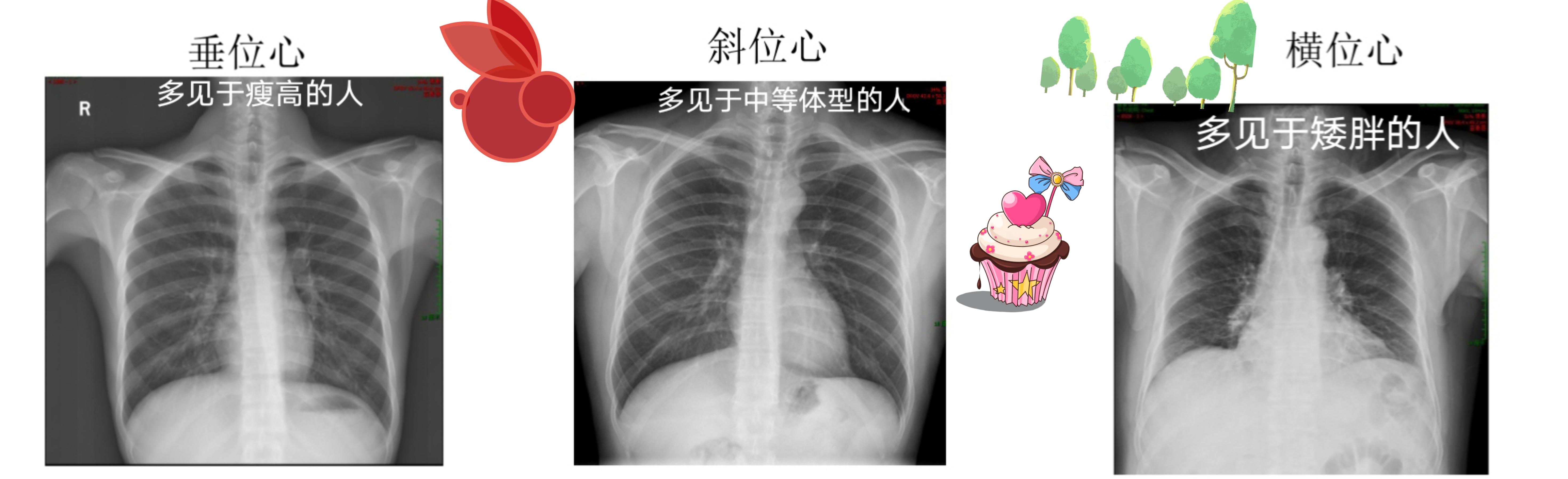 影像知识 的想法: 不同体型的人胸片上心脏的大小不一样