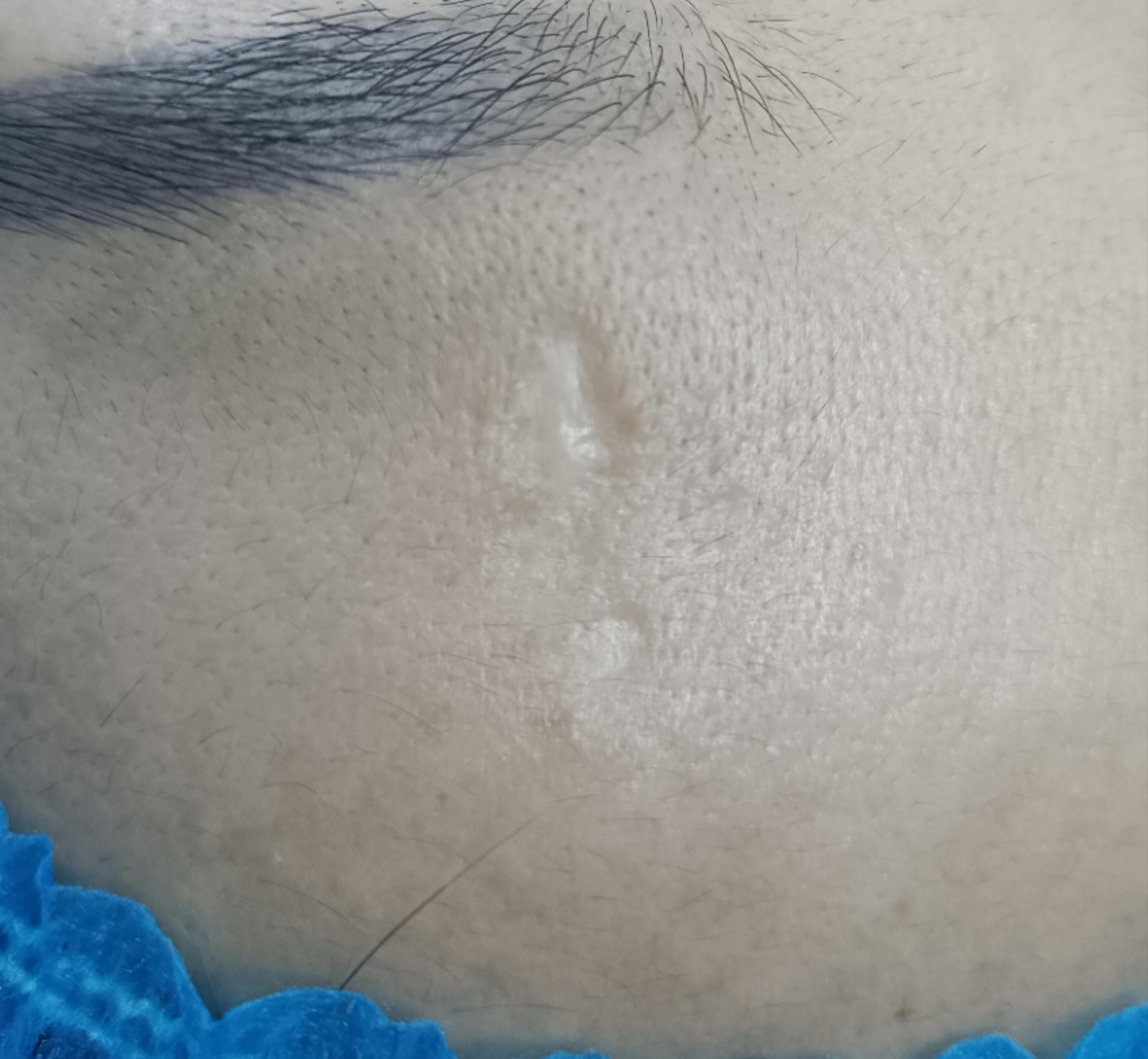 深圳祛疤刘纯源 的想法: 颜面部的凹陷疤痕有哪些方法可以治疗?