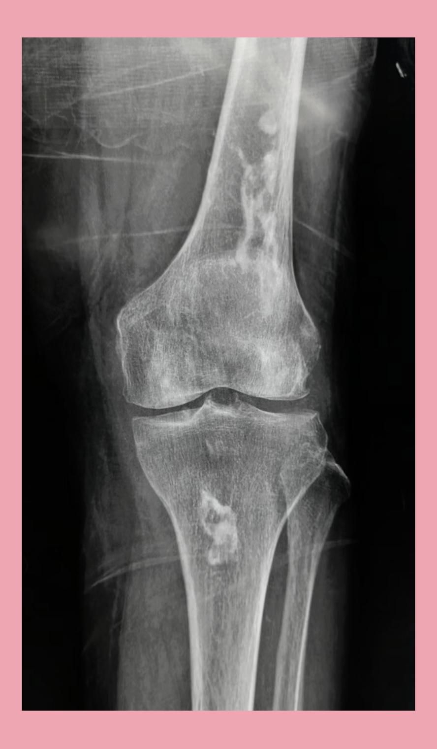 影像技术小知识 的想法: 膝关节正侧位