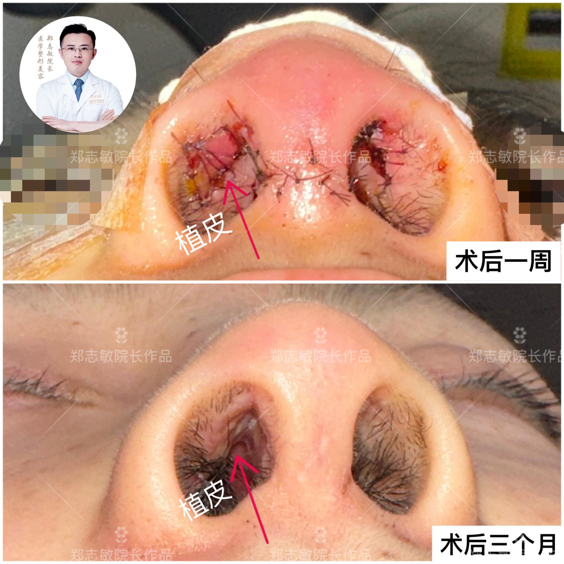 整形医生郑志敏 的想法: 鼻翼缘退缩漏鼻孔植皮术后三个月对比 <a
