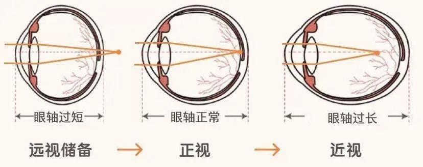 远视眼是怎么回事图片