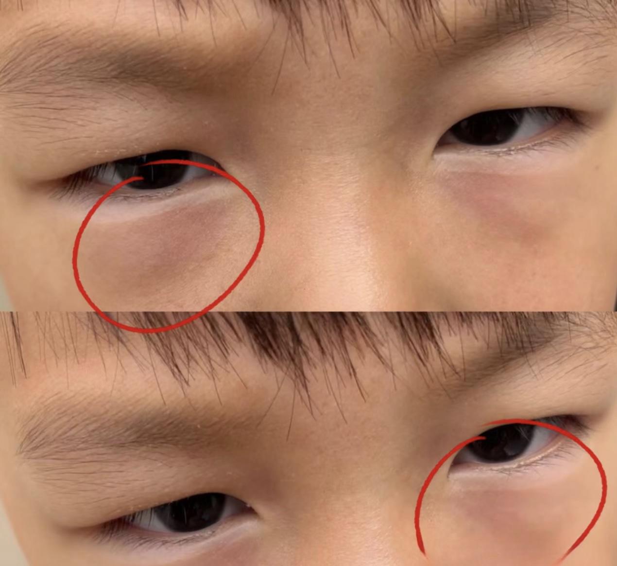 小儿脾胃王田姥爷 的想法: 孩子下眼袋发青,做好这3点,尤其最后一条