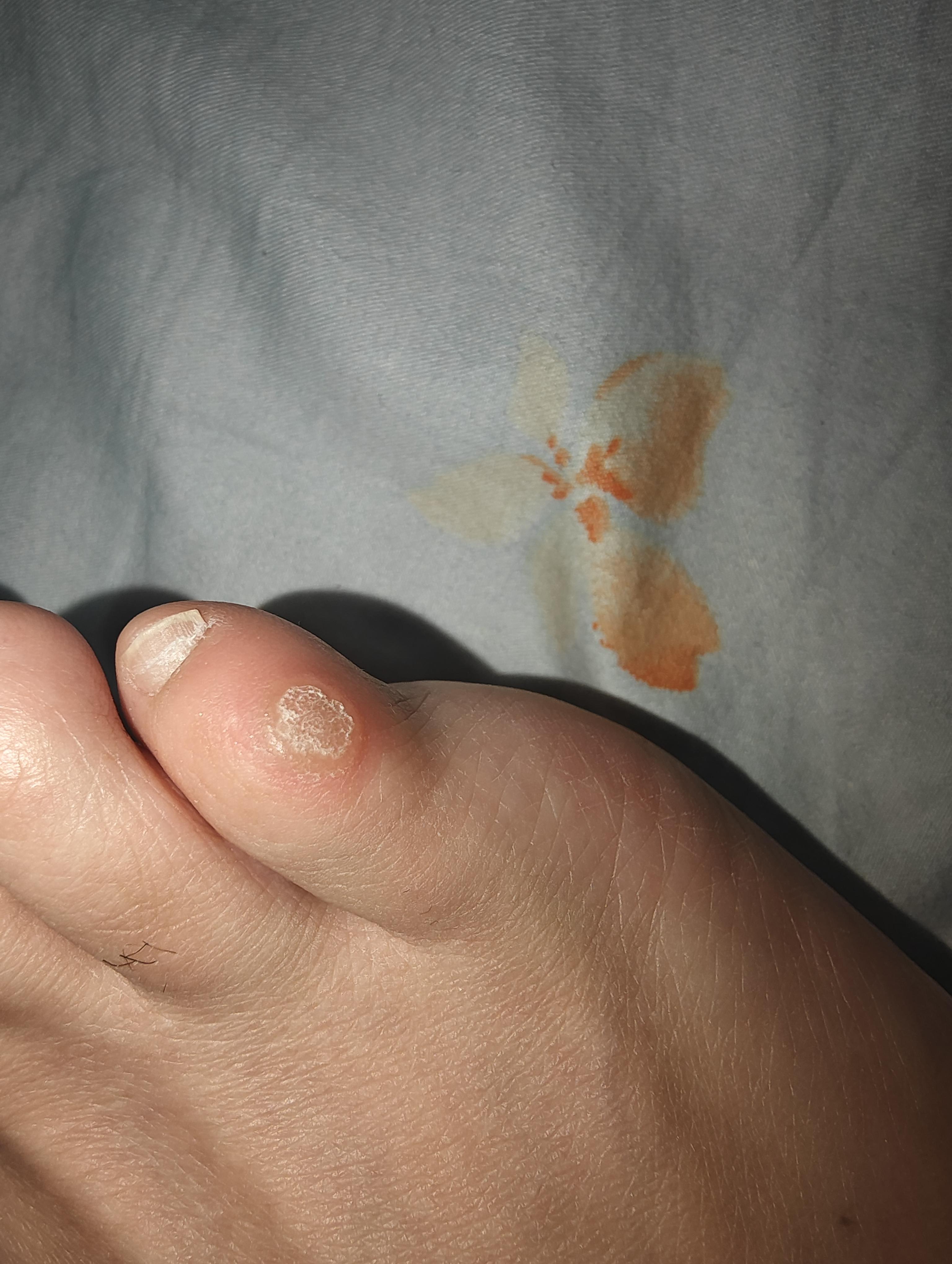 jiangyh 的想法: 小脚趾边上长了一个茧子