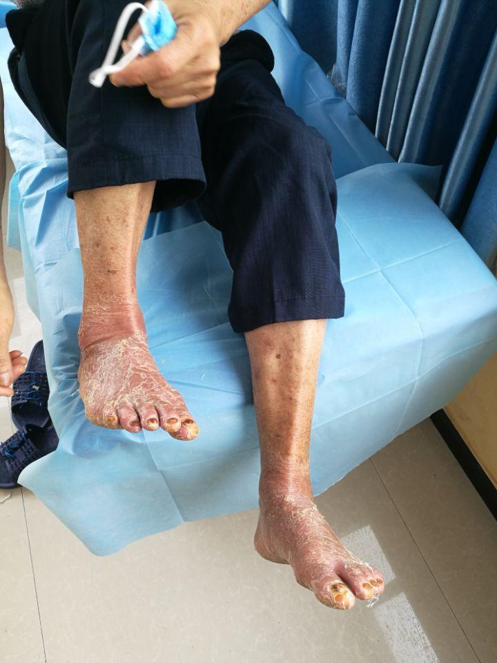 求索道人 的想法: 糖尿病足到底能不能用中医药,效果怎么样