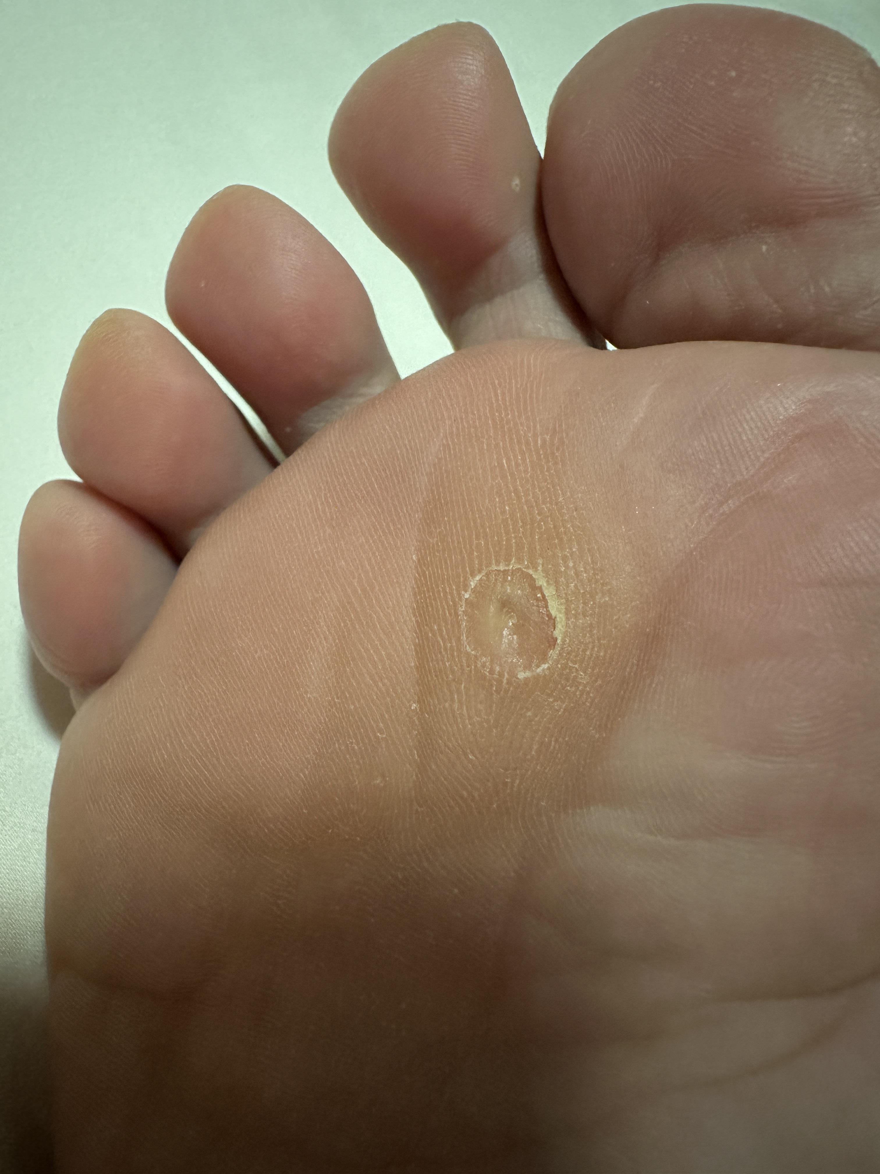 花香满衣 的想法: 鸡眼的冷冻治疗 | 今天又去做了鸡眼的冷
