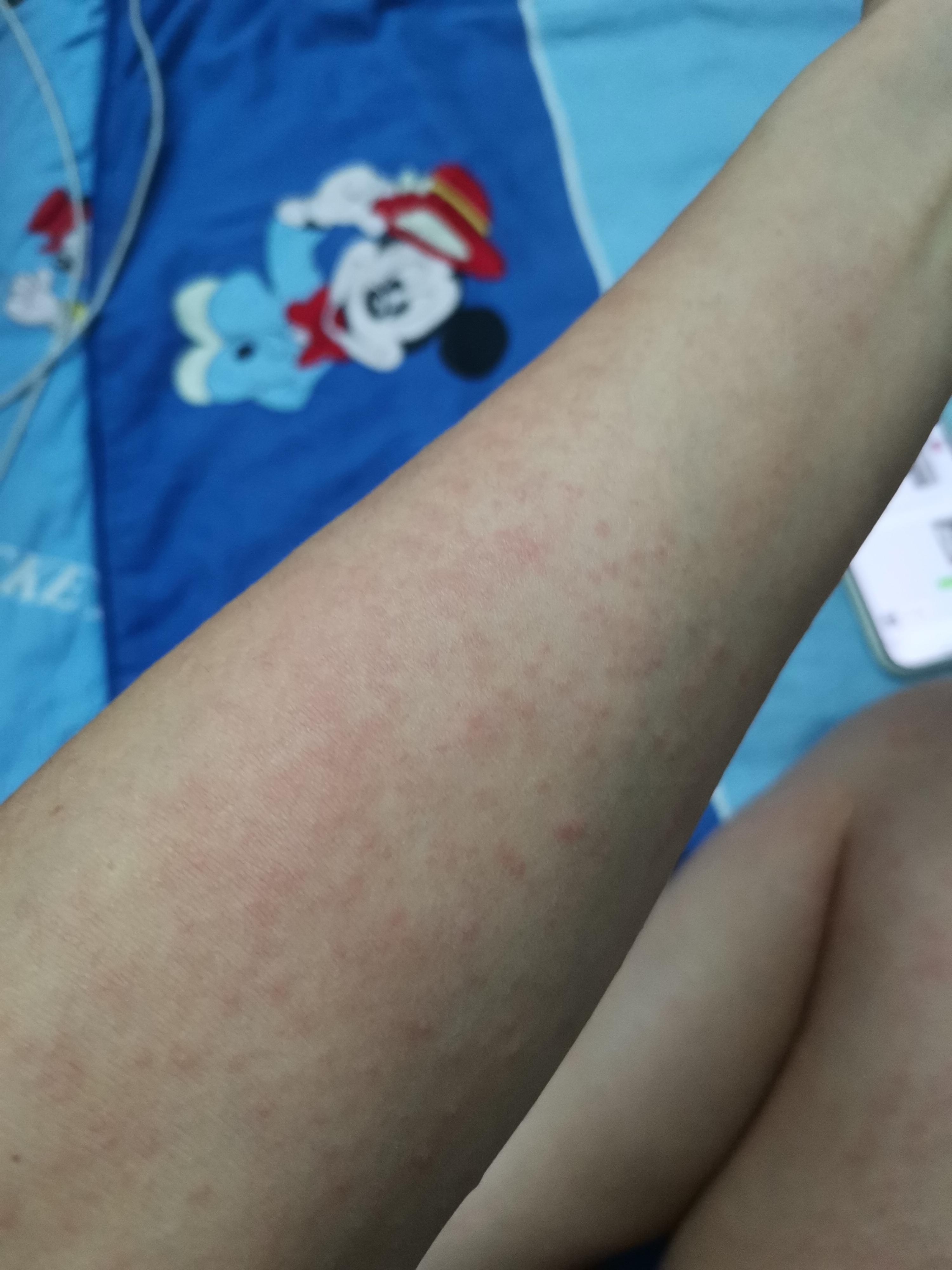 我们 的想法: 倩碧黄油过敏