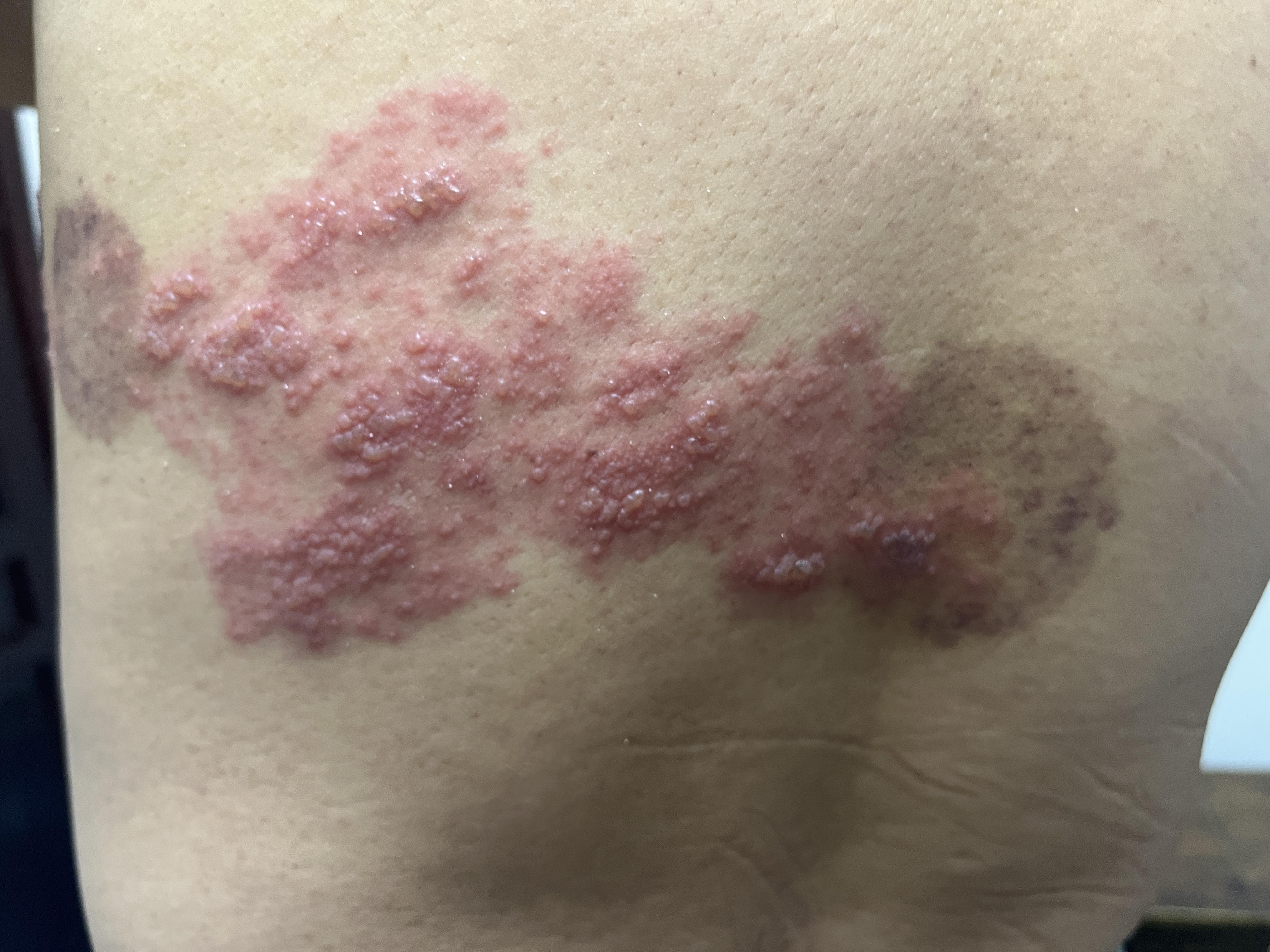 的想法: 很典型的带状疱疹,祖国医学称为"缠腰火丹",俗称"蛇串疮"