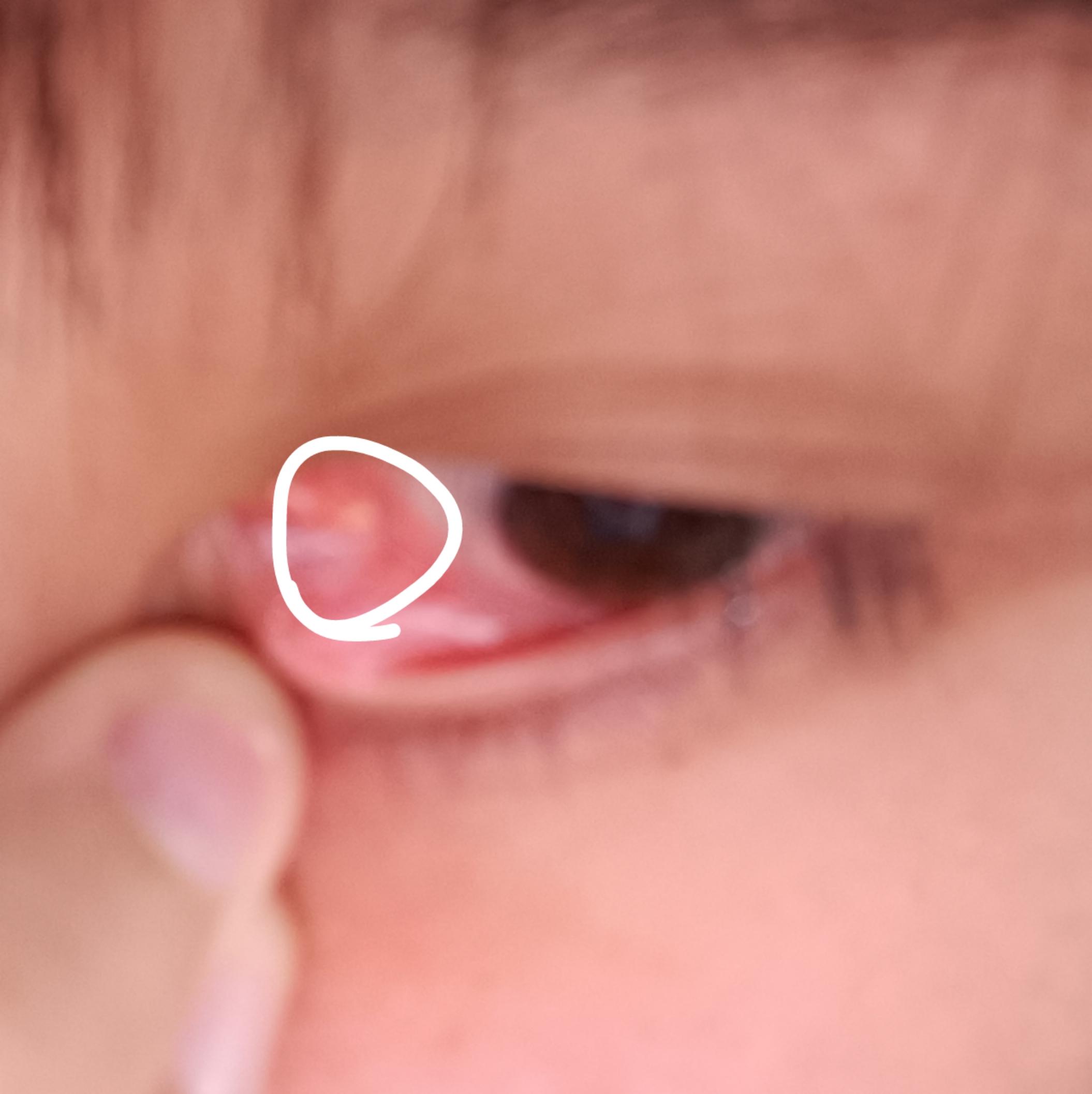 理查德咕咕 的想法: 请问眼角里面有个黄色小颗粒是什么东西啊,用不用