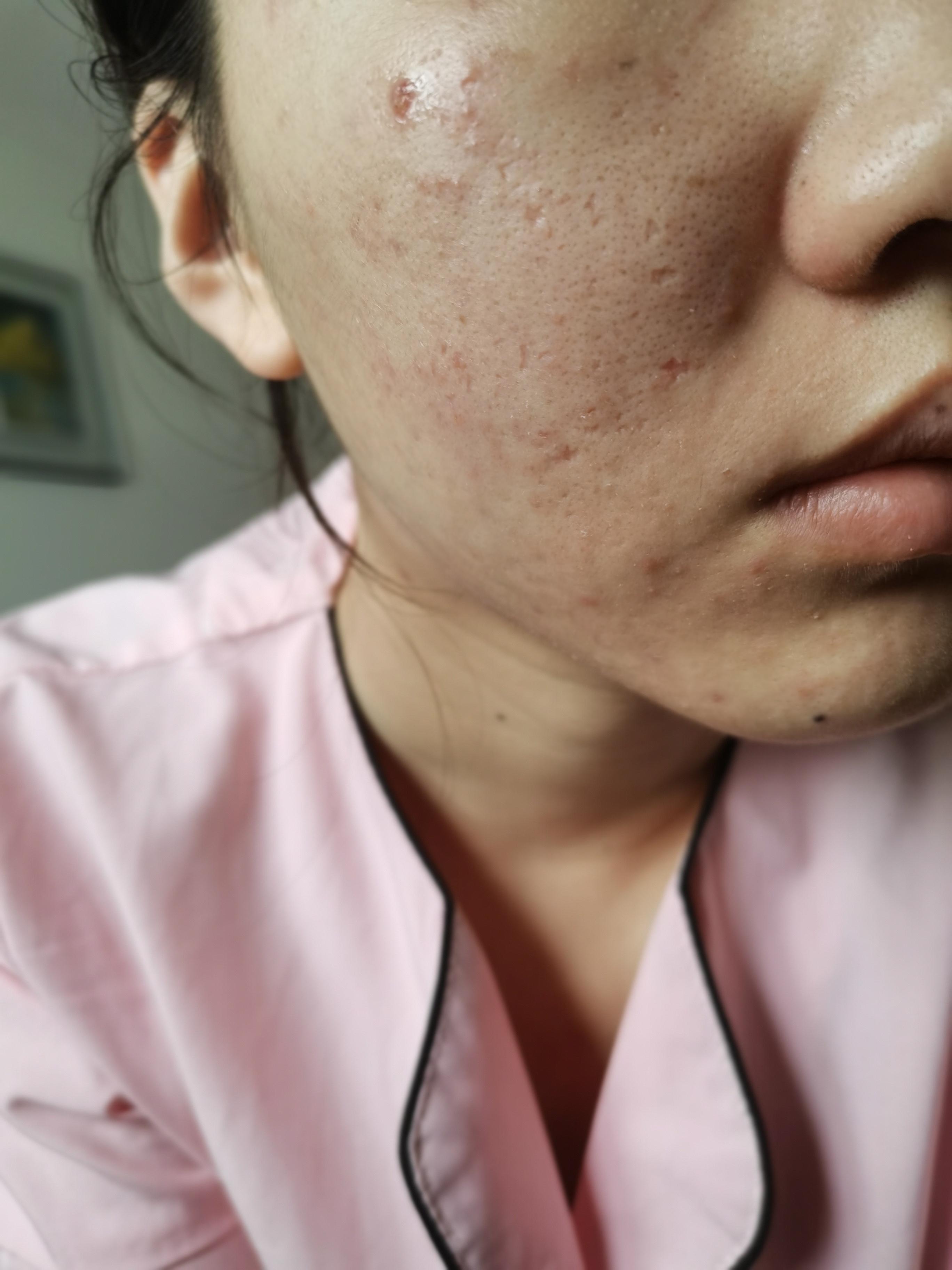 墨璃 的想法: 很难说有没有效果,做过两次点阵,三次微针