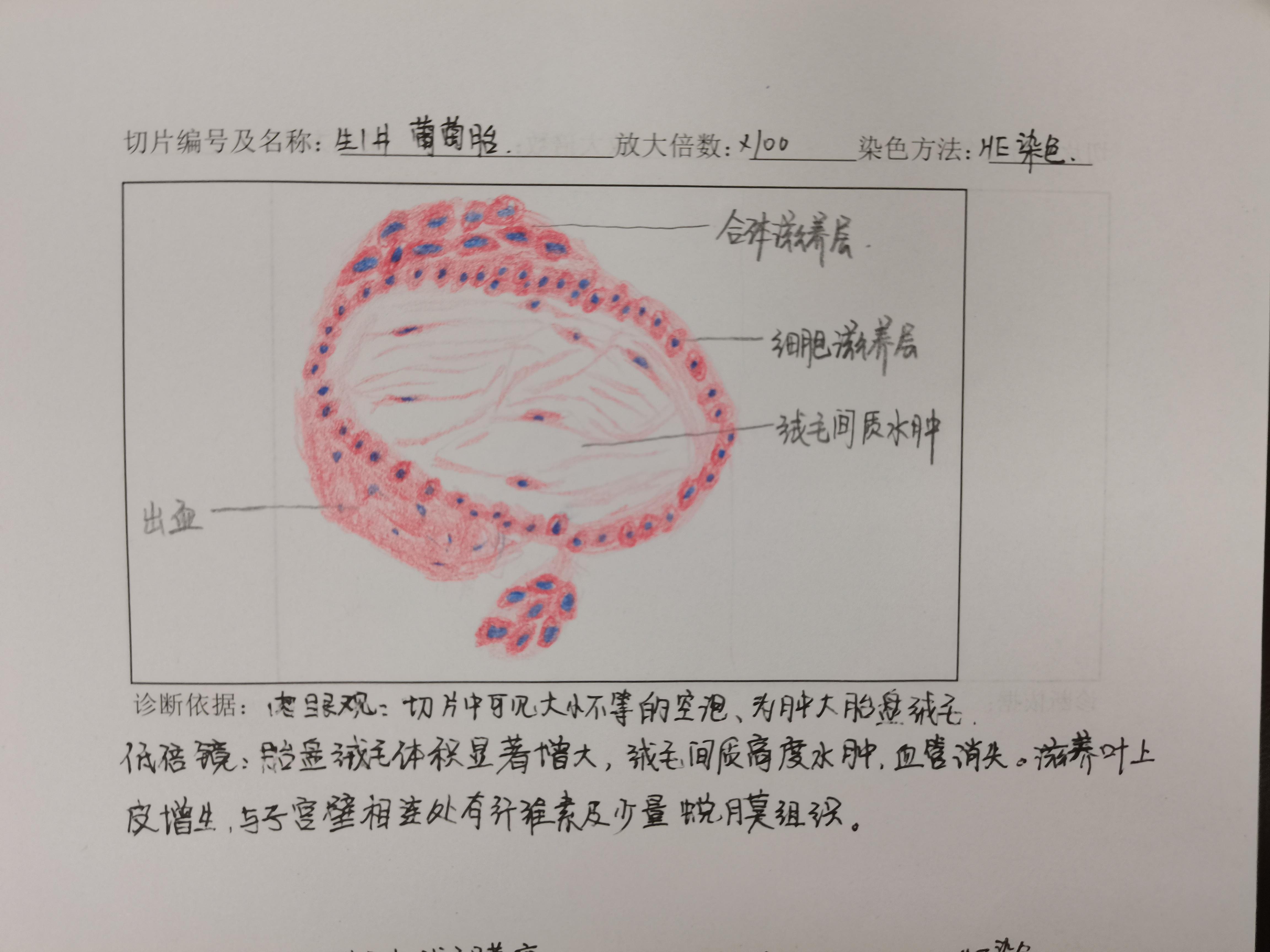 葡萄胎切片绘图图片