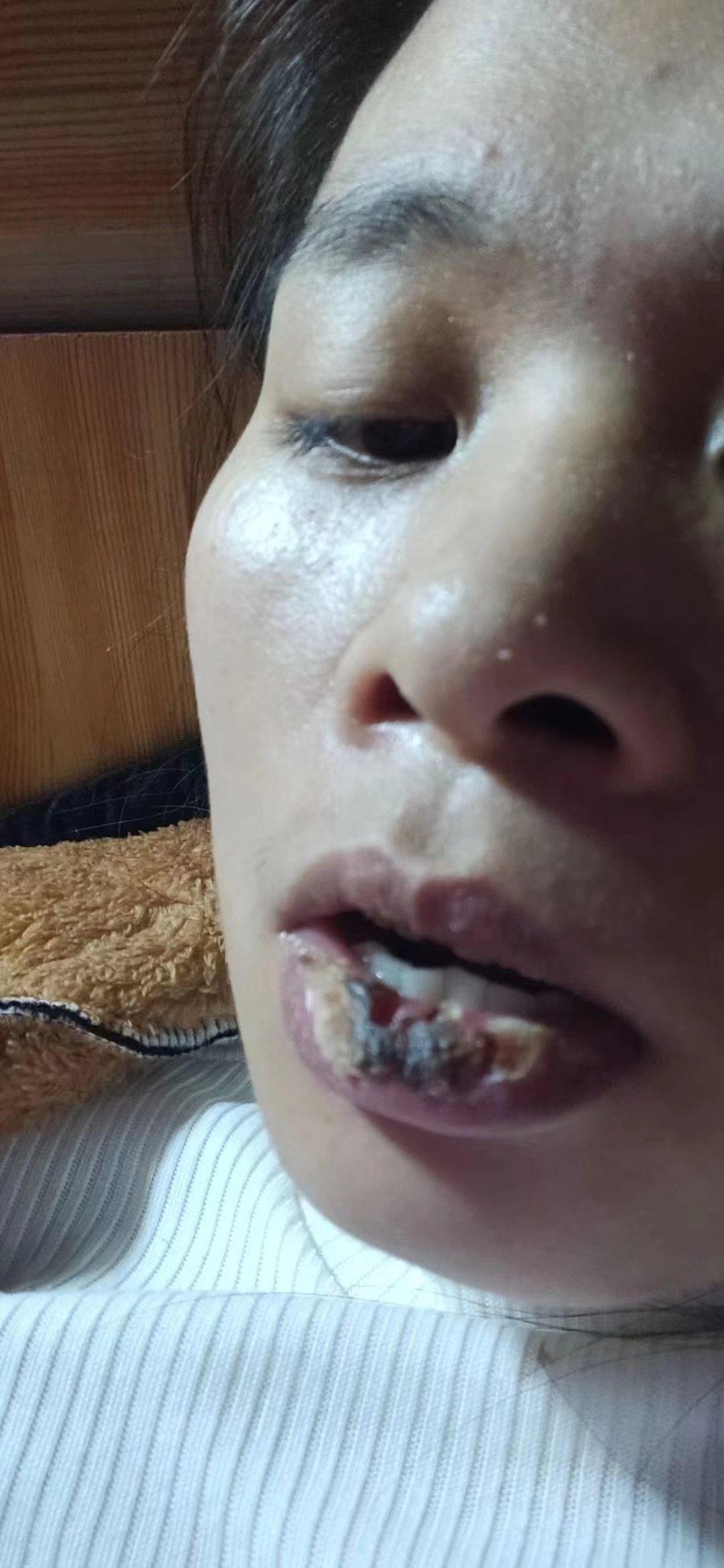 特立独行 的想法: 嘴唇伤疤