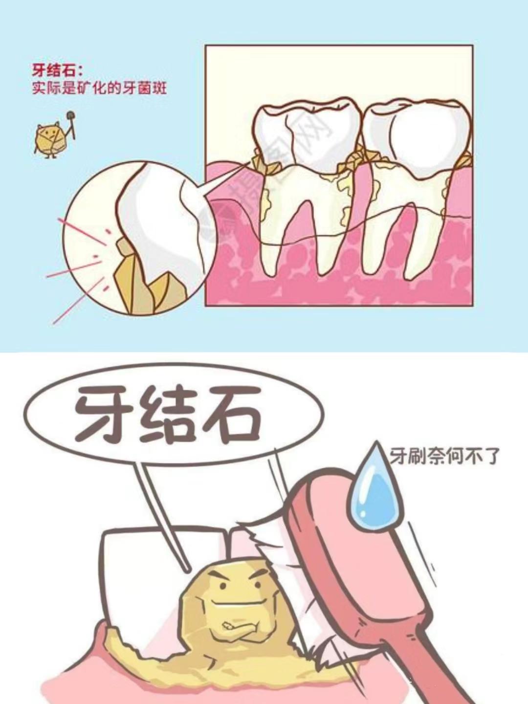 牙结石的预防主要是控制菌斑,增强口腔卫生意识,认真刷牙,早晚2次