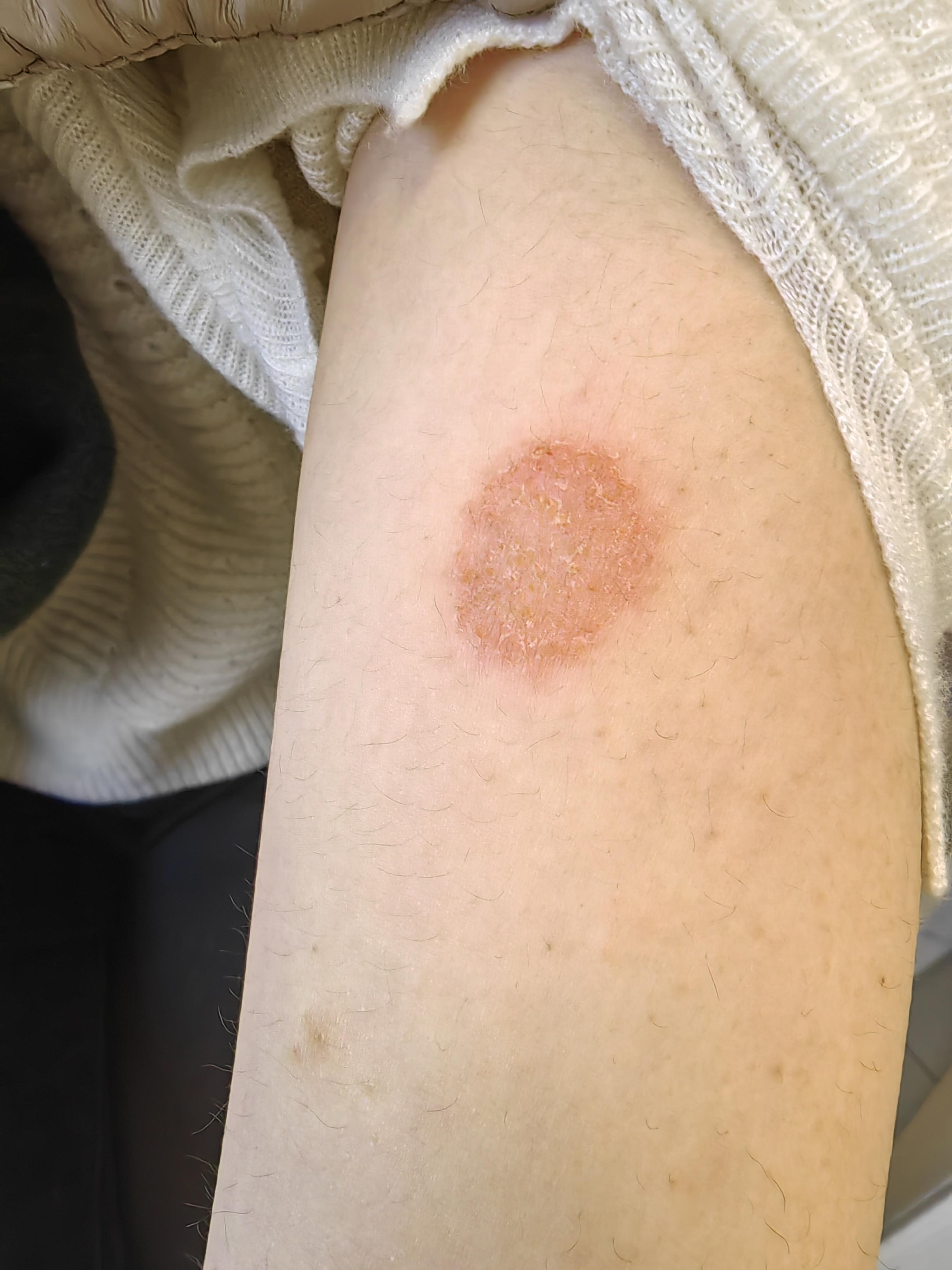 前天来就诊的玫瑰痤疮患者,手臂上有块典型的钱币样湿疹,圆圆的