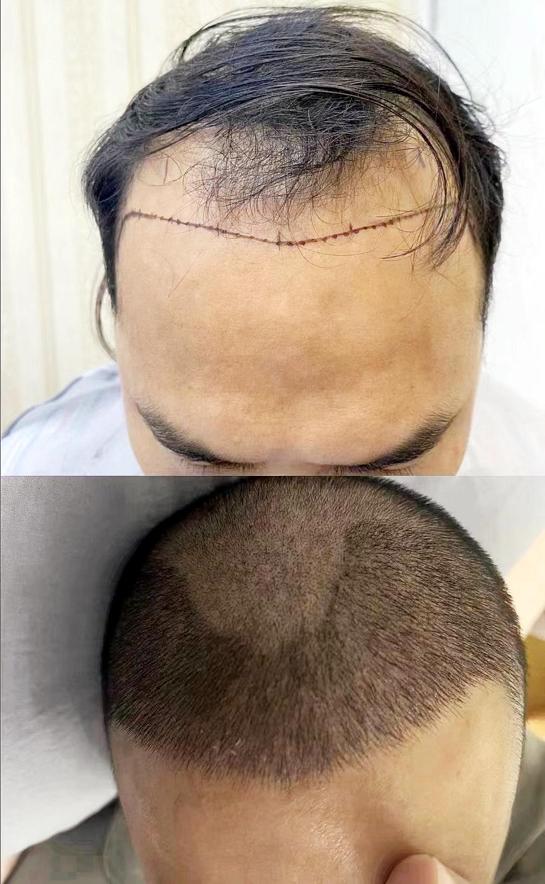 植发老张 的想法: 牛先生植发前后7天的对比图,帅气效果在我们意料之