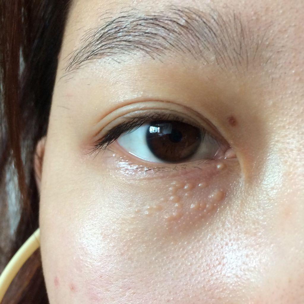 亦乎官方 的想法: 眼周小颗粒是什么?