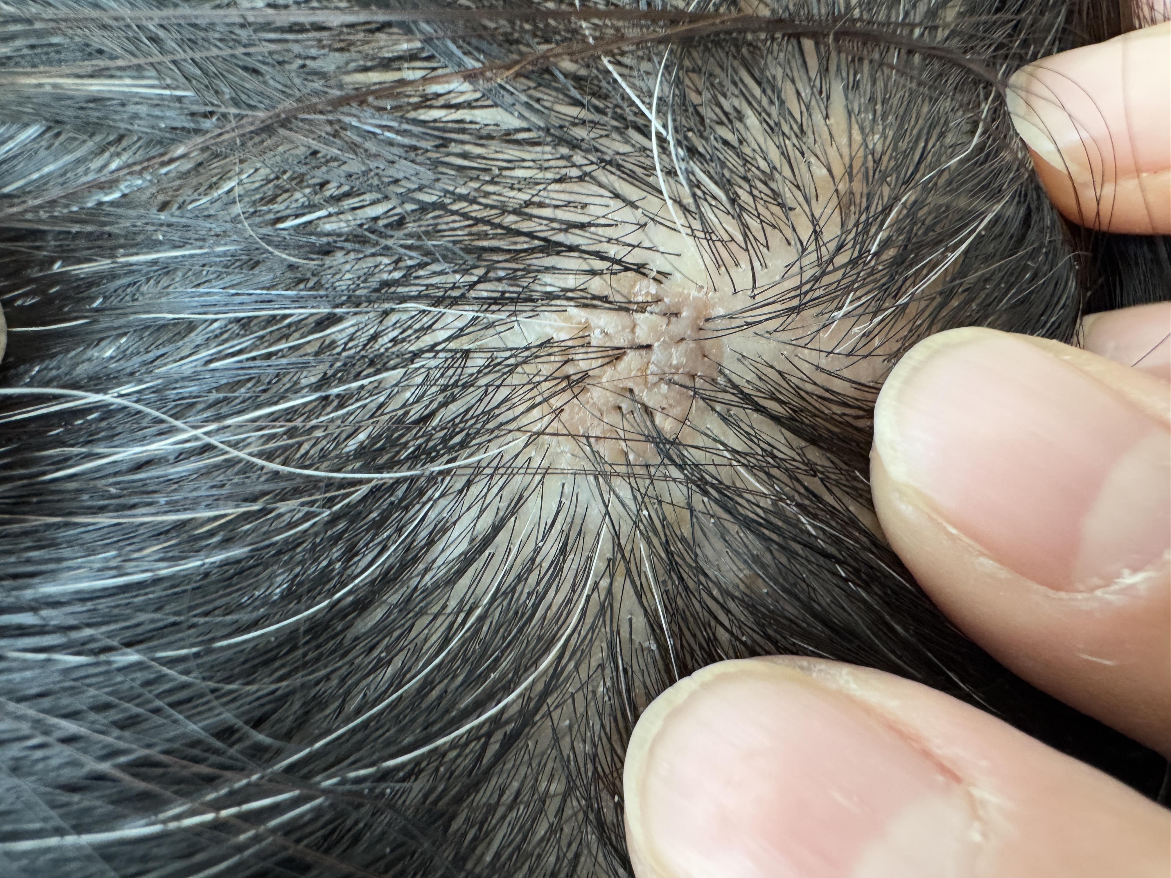 头上的肉疙瘩究竟是什么近年来发现头皮上长了个疙瘩不痛不痒但却在