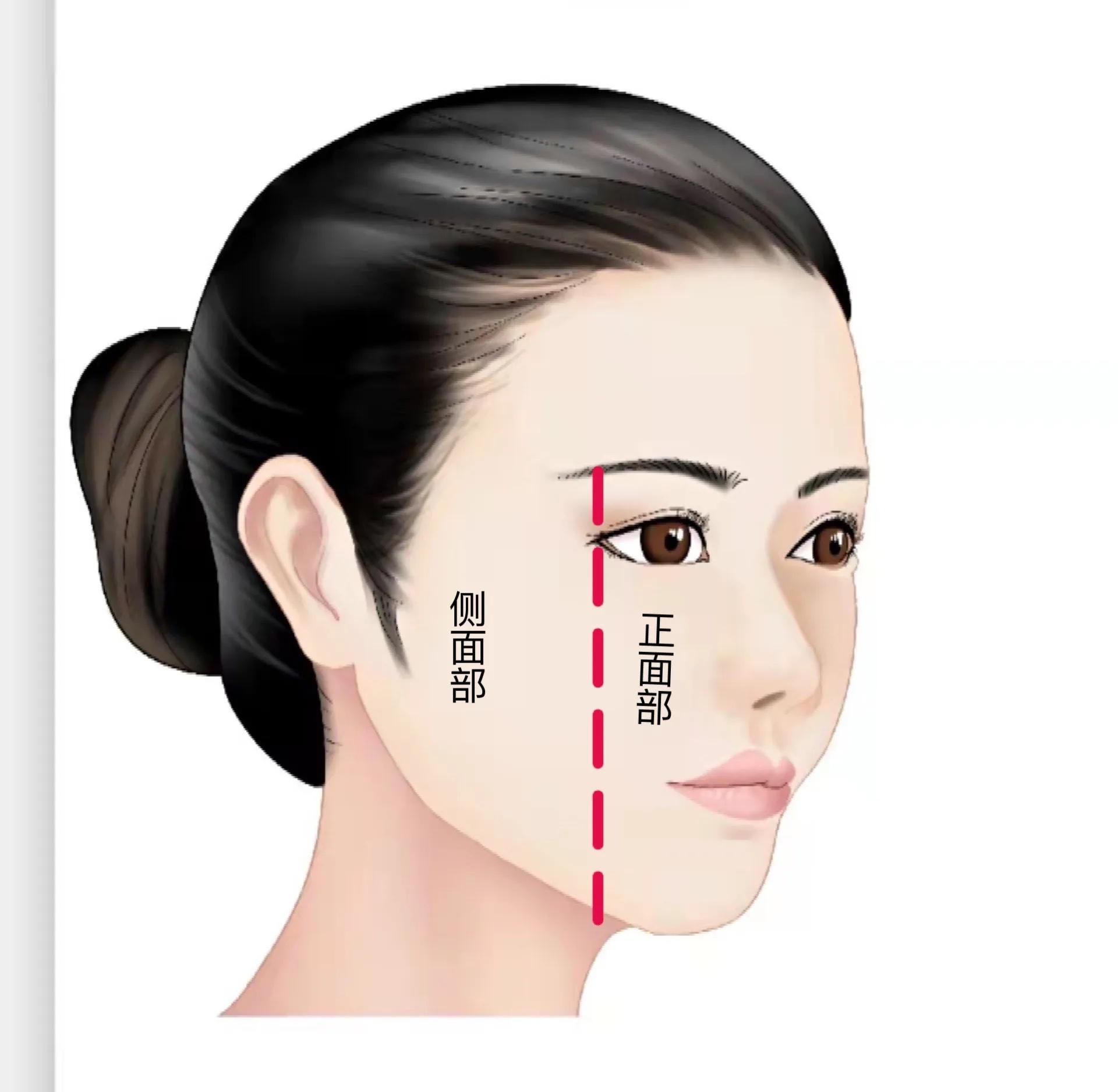 整形外科王晓阳医生 的想法  smas筋膜以外眦垂线为界限