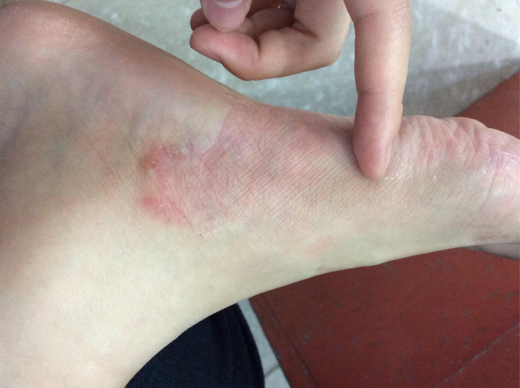 请问我这是湿疹吗? 从我手指的地方一直蔓延上