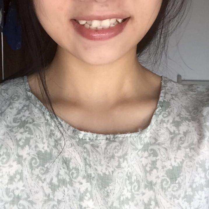 请问带牙套是怎样的一种体验? - 匿名用户的回