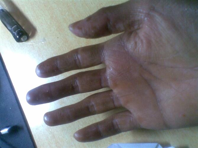 部分黑硬的皮肤开始脱落,长出新皮肤