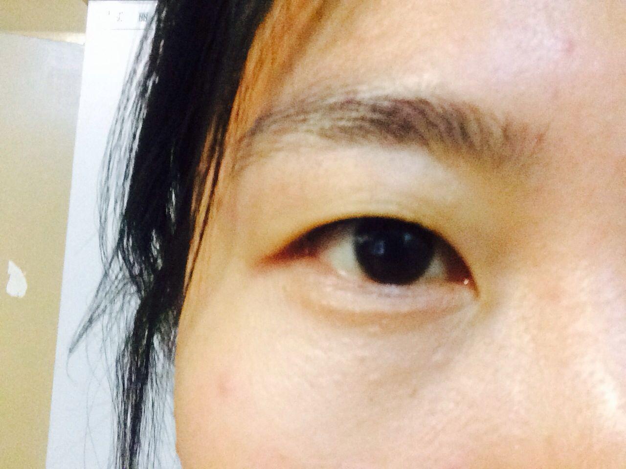 我这样的眼睛适不适合开眼角、割双眼皮? - 整